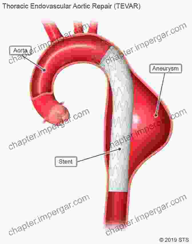 Cardiac Surgeon Performing A Thoracic Aorta Replacement Key Questions In Thoracic Surgery