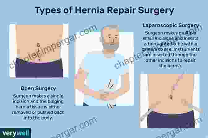 Thoracic Surgeon Repairing A Diaphragmatic Hernia Key Questions In Thoracic Surgery